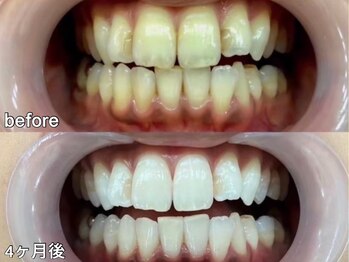 グラーティア 梅田店(gratia)/ホワイトニング★4ヶ月目★