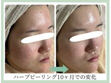 【ハーブピーリング】お肌悩み別で選べるハーブピーリング