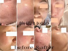 パール(PEARL)/施術1回、１ヶ月後…B A写真