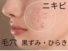 《ニキビケア》【毛穴洗浄×ヒアルロン酸orビタミンC導入60分5500円】