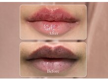 モニ(moni.)/メラニンケア「ルメラ」