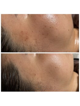 リアンジェ(Lianje)/ピーリング