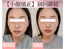 リラハウス(Lila House)の雰囲気（[２０代女性]施術回数４回お顔全体のたるみ／Before-After）