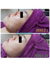 ラセンシアアンジュ(Lasencia Ange)/ハーブピーリング　1回施術経過