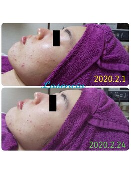 ラセンシアアンジュ(Lasencia Ange)/ハーブピーリング　1回施術経過