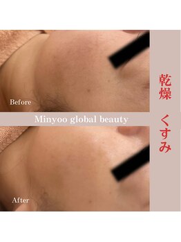 ミニョ コリアンビューティー(Minyoo korean beauty)/症例写真/乾燥、くすみ