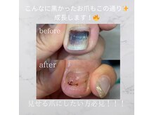 シャドウ(shadow)の雰囲気（トラブルフットお任せあれ^_^巻き爪、肥厚爪大歓迎！！）