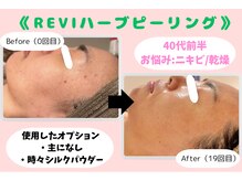 ウル 下北沢(Ulu)/REVIハーブピーリング