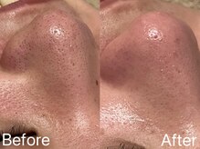 シェリーミル(Cherie Miru)/毛穴エクストラクション