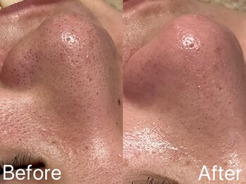 シェリーミル(Cherie Miru)/毛穴エクストラクション