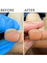 クオッカ(Quokka)/第二趾の巻き爪ケア