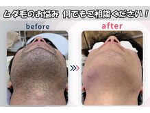 頑固なヒゲにも効果◎☆ヒゲ脱毛/眉/メンズ脱毛