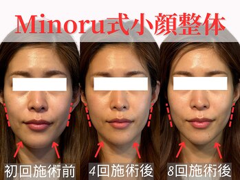 フレキシボディ(FlexiBody)/小顔施術ビフォーアフター #12