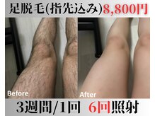 アップパイン(UPPINE)/足脱毛¥4,400(初回価格)