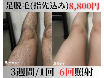 アップパイン(UPPINE)/足脱毛¥4,400(初回価格)