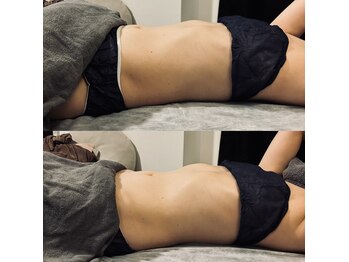 ベリッシマ筋膜セラピー/腸もみの効果