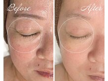 ルポ 鶴見(Repos)/目元のシワケアはプラズマで★