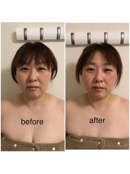 ココ(coco)/小顔リフト&ラジオ波