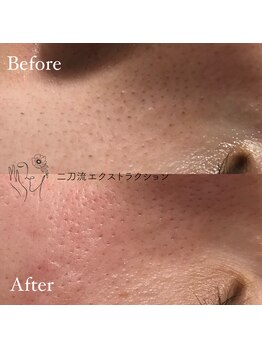 毛穴ケアサロン そらな/鼻だけじゃない!毛穴汚れ除去!