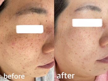 サクラ 伊勢原店(SAKURA)/こんなに変化◎当フェイシャル◎