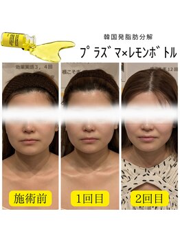 トリニティスペース(TrinitySpace)/レモンボトルビフォーアフター