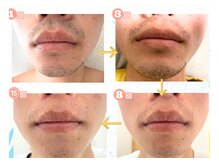 セルフダック いわき小名浜店(SELFDUCK)/◇ヒゲ脱毛のBeforeAfter！