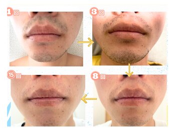 セルフダック いわき小名浜店(SELFDUCK)/◇ヒゲ脱毛のBeforeAfter！