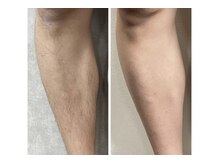 リッカ 学芸大学(RIKKA)/男性　足脱毛　ビフォーアフター