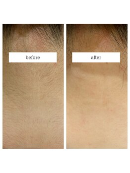 ミーティスジータ(mitis Gita)/脱毛