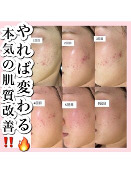 ホワイトアクア 天王寺本店(WHITE AQUA)/ハーブピーリング/大阪/天王寺