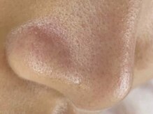 毛穴洗浄にて毛穴レスなたまご肌へ◎毛穴黒ずみでお悩みの方に◎