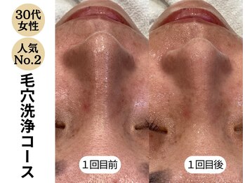 ディレイア ザ コスメ 有楽町マルイ店(direia the cosme)/毛穴洗浄/角栓［有楽町］