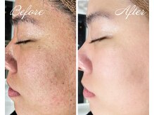 ルポ 鶴見(Repos)/肌荒れはプラズマで一撃★