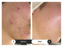 リジュ(Reje)/赤み&ニキビケア