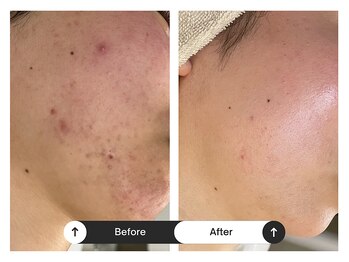 リジュ(Reje)/赤み&ニキビケア