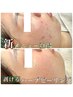 【5日後の自分に感動】剥けるハーブピーリングでつるんと卵肌