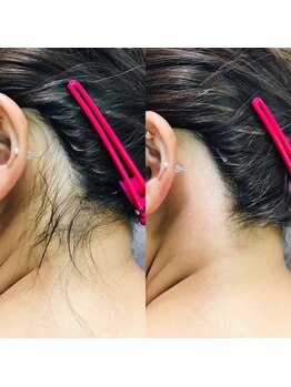 ワックスラボ(WAXLAB)/うなじWAX+うなじ光脱毛