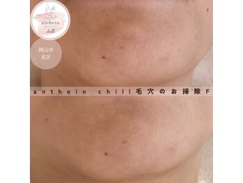 アンテイン チル(anthein chill)/毛穴のお掃除フェイシャル
