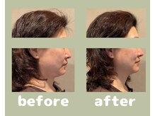 プラス(APLUS)/美容鍼灸　施術前後