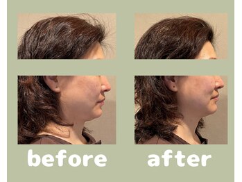 プラス(APLUS)/美容鍼灸　施術前後