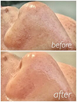 シス(SiS)/ハイドラ/角栓除去