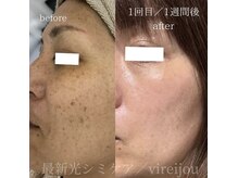 プライベートアイラッシュサロン ヴィレージュ 稲毛店(Vireijou)/大人気のシミケアで悩み解決！