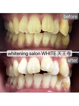 ホワイト 天王寺店(White)/Whitening症例before→after