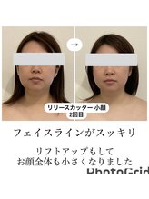 グローボックス(GLOW BOX)/ビフォーアフター