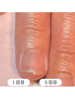 ココデネイル(cocode nail)/ケア5回でこの変化!