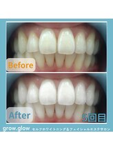 グロウ グロウ(grow.glow)/医療提携ホワイトニング