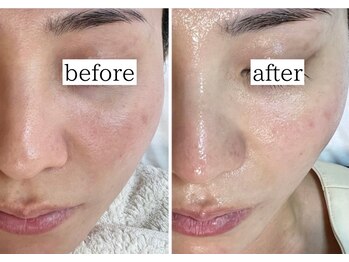 エクレ(eclat)/アクネ菌を殺菌ケア