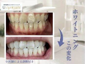 シアホワイト(CIA WHITE)/劇的ビフォーアフター