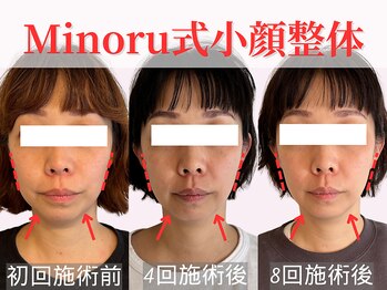 フレキシボディ(FlexiBody)/小顔施術ビフォーアフター #13