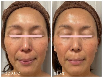 ムム(MooMoo)/ヒト幹細胞導入+石膏パック